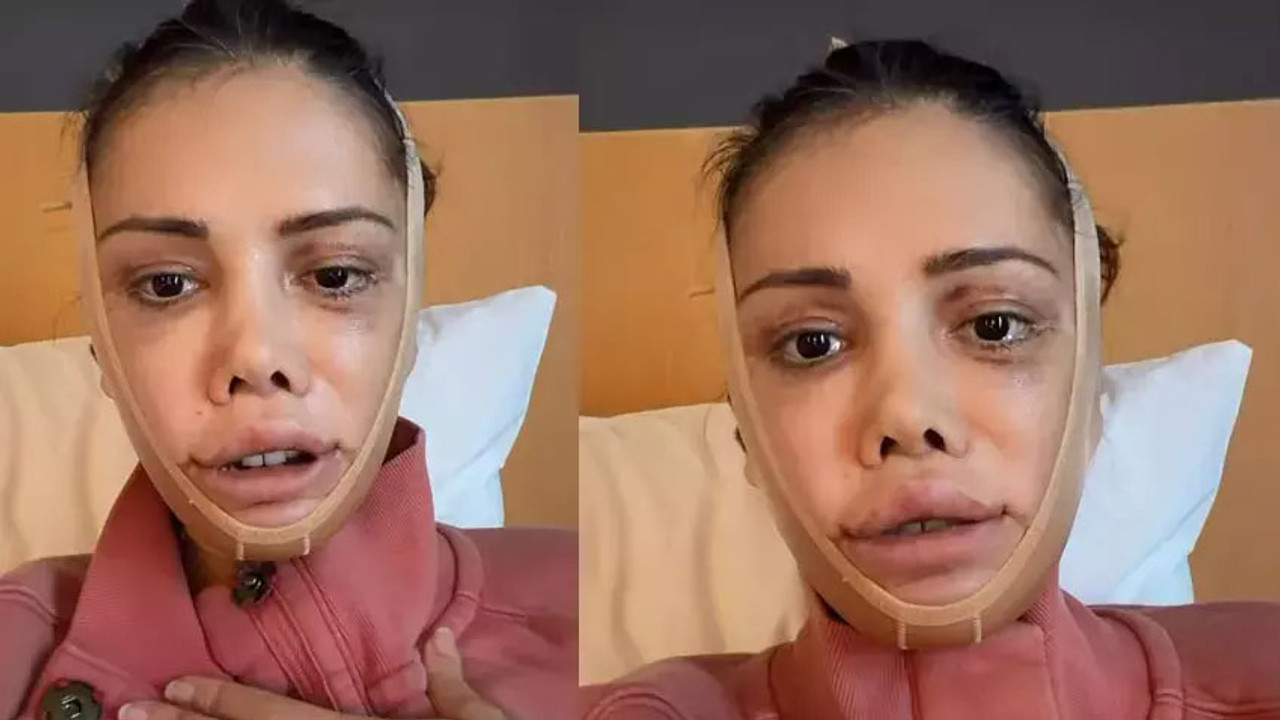 Ameliyatı 2 gün sürdü! Yüz nakli geçiren Didem Ceran'ın son hali olay oldu