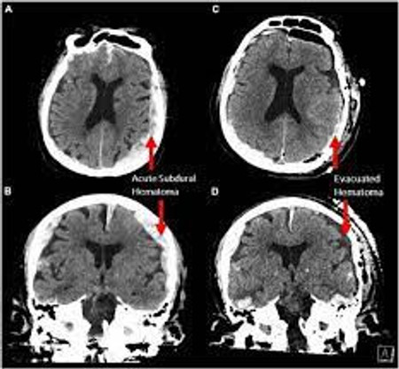 Bilim insanları, ölen hastanın tesadüfen beyin hareketlerini kaydetti - Resim : 1
