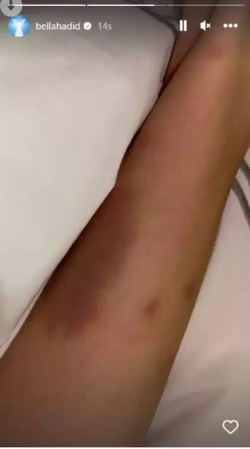 Ünlü model hastalığını bantlarla duyurdu - Resim : 2