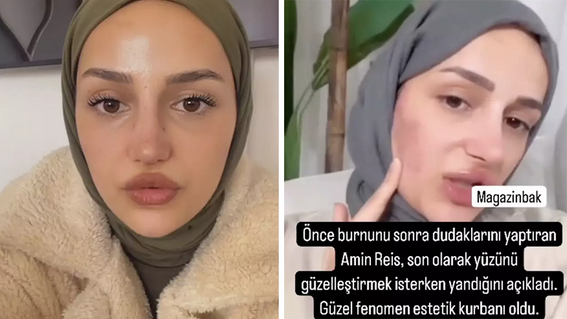 'Amin Reis'in güzellik hayali kabusa döndü! Tiktok fenomeninin yüzü böyle yandı - Resim : 1