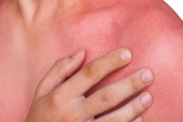 Fucidin krem yanığa iyi gelir mi?