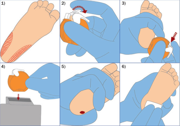 Topuk Kanı Nasıl Alınır?