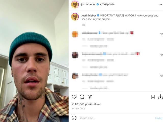 Justin Bieber’dan sevenlerini üzen paylaşım: “Yüzümün bir tarafı felçli” - Resim : 1