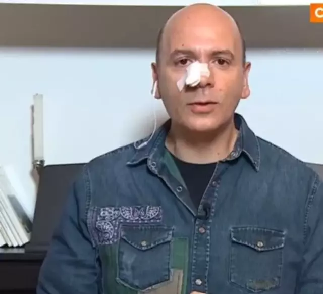 Burnu kanadı, Atv ana haber'i sunamadı! Ünlü haber spikeri son durumunu anlattı - Resim : 3