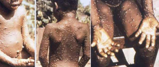 Korona bitmeden yeni virüs şoku! İngiltere'de ölümcül maymun çiçeği virüsü tespit edildi! - Resim : 1