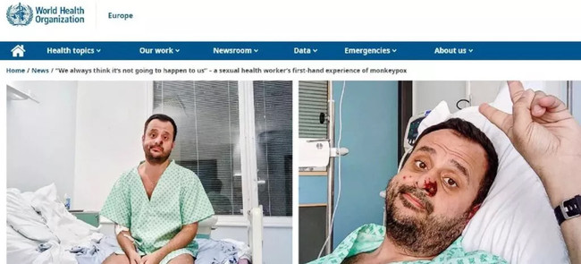 Maymun çiçeğine yakalanan Türk BM'nin sitesinde yayınlandı! "Sanırım öleceğim" - Resim : 2