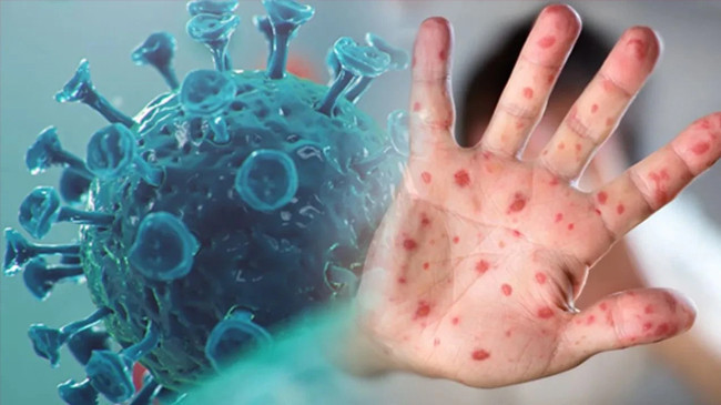 DSÖ’den ürküten açıklama! M çiçeği virüsü dünyanın birçok ülkesine yayıldı - Resim : 1