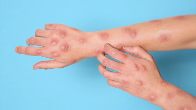 DSÖ’den ürküten açıklama! M çiçeği virüsü dünyanın birçok ülkesine yayıldı - Resim : 2