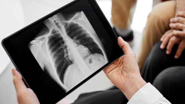 Kanser tedavisinde umut veren gelişme! Kan testi ile önceden tespit edilecek - Resim : 1