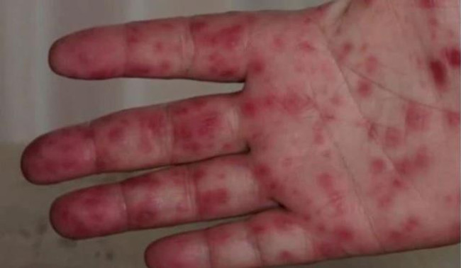 Eyvah eyvah! Başımıza şimdi de domates gribi çıktı, işte ilk belirtileri - Resim : 1