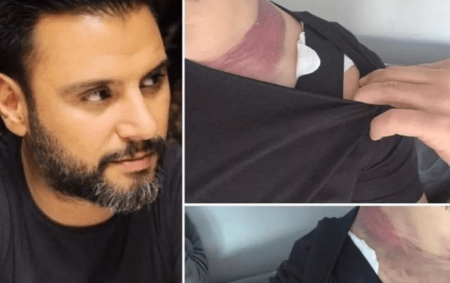 Alişan ölümden dönmüştü! Yağ aldırma davasında karar çıktı - Resim : 1