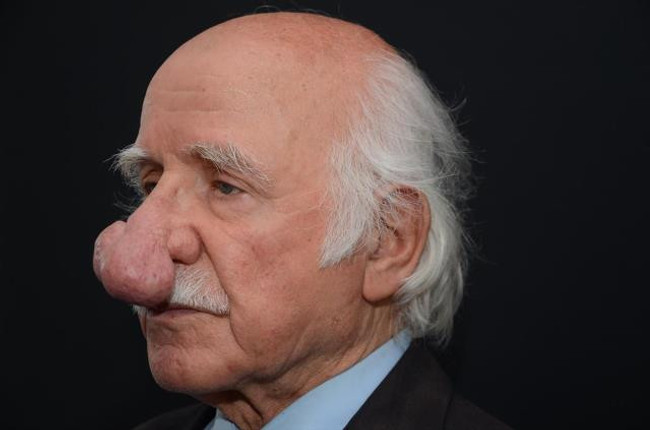 Burnundaki yarayı kurcalayınca bu hale geldi! 84 yaşındaki adam, kitleden ameliyatla kurtuldu - Resim : 1