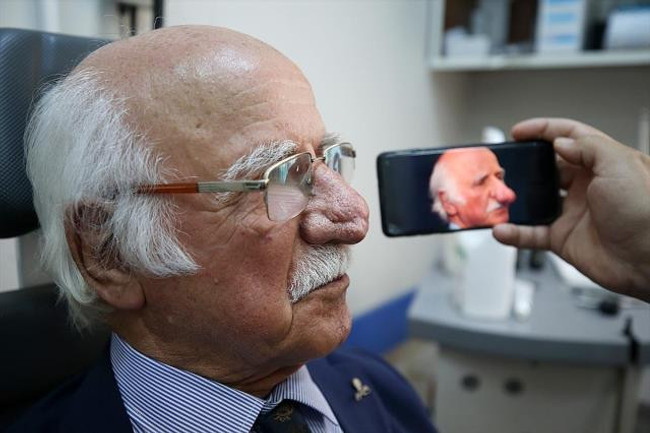 Burnundaki yarayı kurcalayınca bu hale geldi! 84 yaşındaki adam, kitleden ameliyatla kurtuldu - Resim : 3