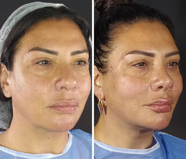 Işın Karaca estetik sonrası paylaştı! ‘Yaşlanmak yok, bugünü kendimi yenilemeye adadım…’