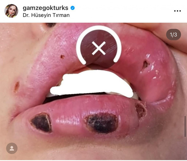 Kısmetse Olur yarışmacısı Gamze Göktürk estetik kurbanı oldu! O doktorla ilgili olay CNN Türk detayı - Resim : 2