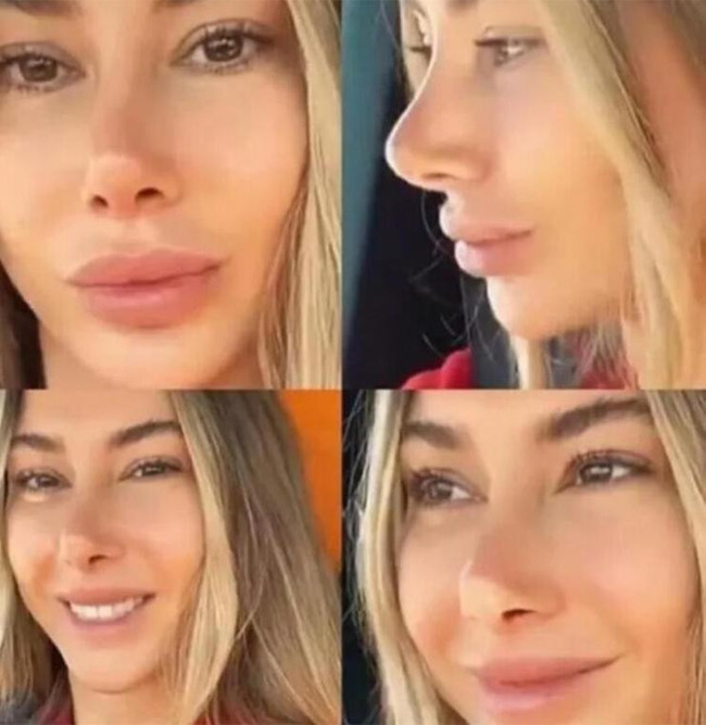 Estetik ameliyatı olan Şeyma Subaşı hastanelik mi oldu? - Resim : 1