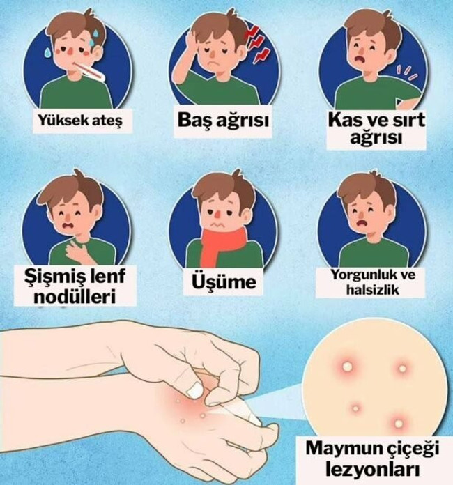 En çok tehdit altında olanlar belli oldu! İşte maymun çiçeği virüsünde yüksek risk grupları… - Resim : 1