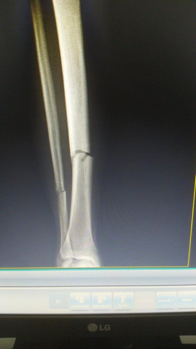 Fernando Muslera'nın ayağı kırıldı! Acı haber geldi - Resim : 1