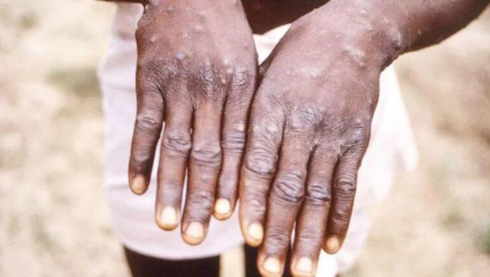 Ülkeler alarma geçti, yeni pandemi korkusu başladı! Cinsel yolla bulaşıyor! - Resim : 1