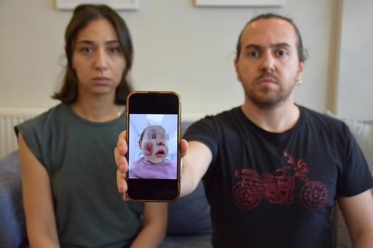 İki yaşındaki bebeğe kreşte dayak: "Yüzü parçalanmış" - Resim : 1