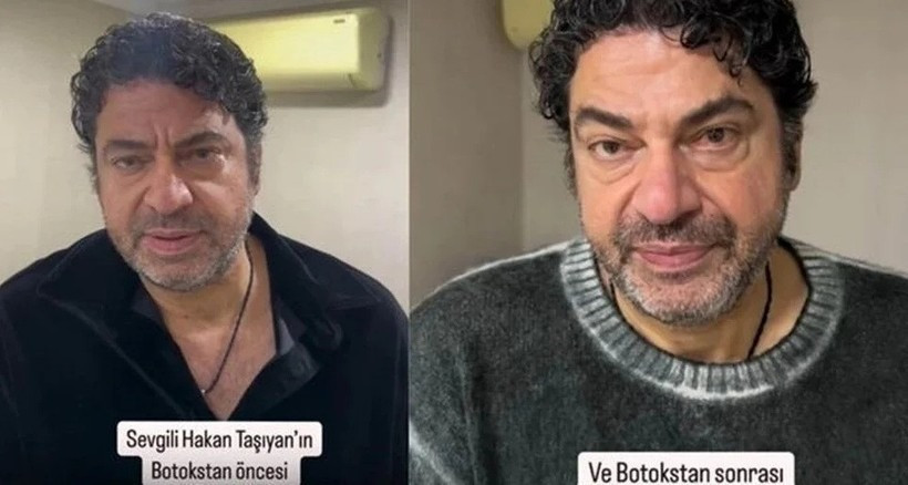 Sağlık sorunlarıyla gündeme gelmişti: Hakan Taşıyan botoks yaptırdı - Resim : 1
