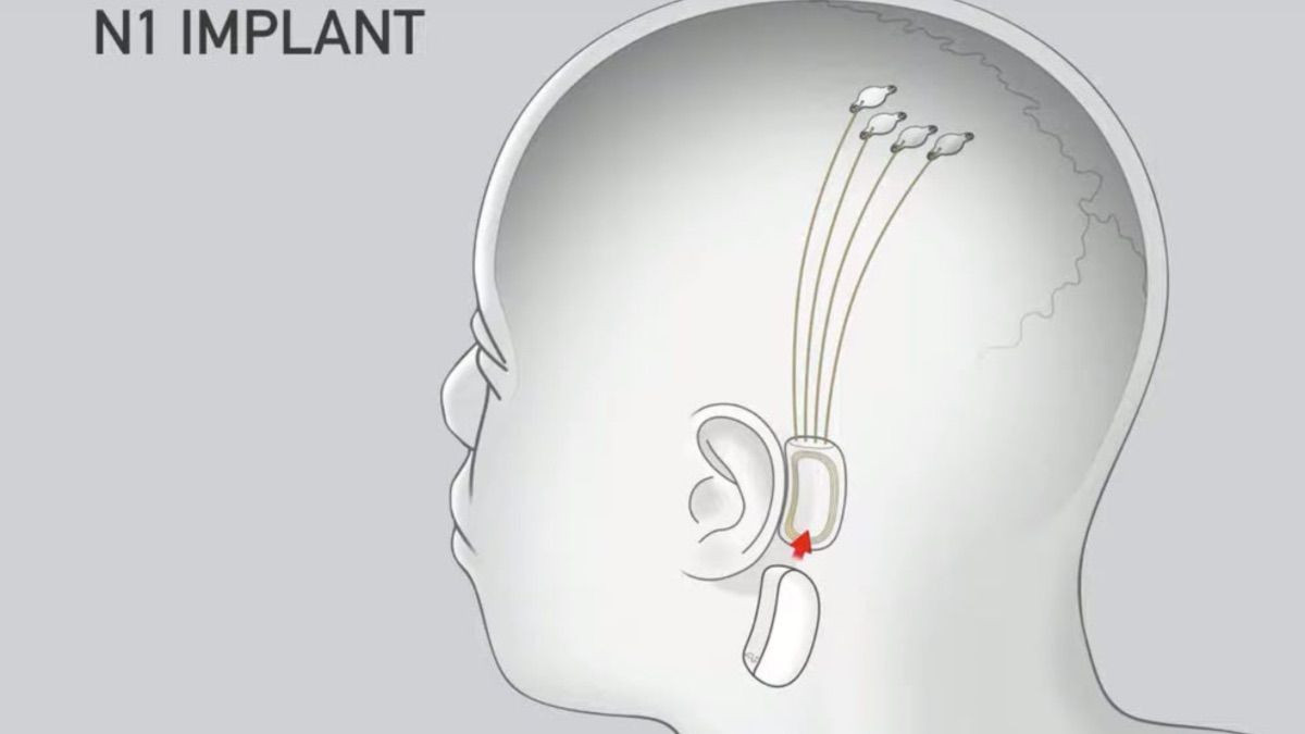 Elon Musk’ın Neuralink projesinden kötü haber: 23 maymundan 15’i öldü - Sayfa 7