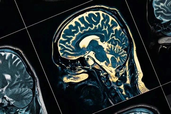 Alzheimer'ı 6 yıl önceden haber veren belirti: Eğer yürürken bunu yaşıyorsanız... - Sayfa 10