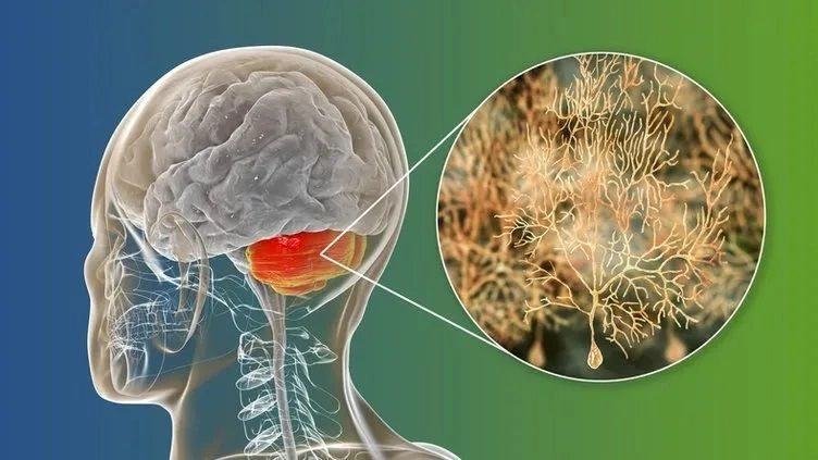 Alzheimer'ı 6 yıl önceden haber veren belirti: Eğer yürürken bunu yaşıyorsanız... - Sayfa 5