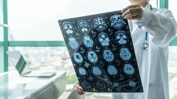 Alzheimer'ı 6 yıl önceden haber veren belirti: Eğer yürürken bunu yaşıyorsanız... - Sayfa 6