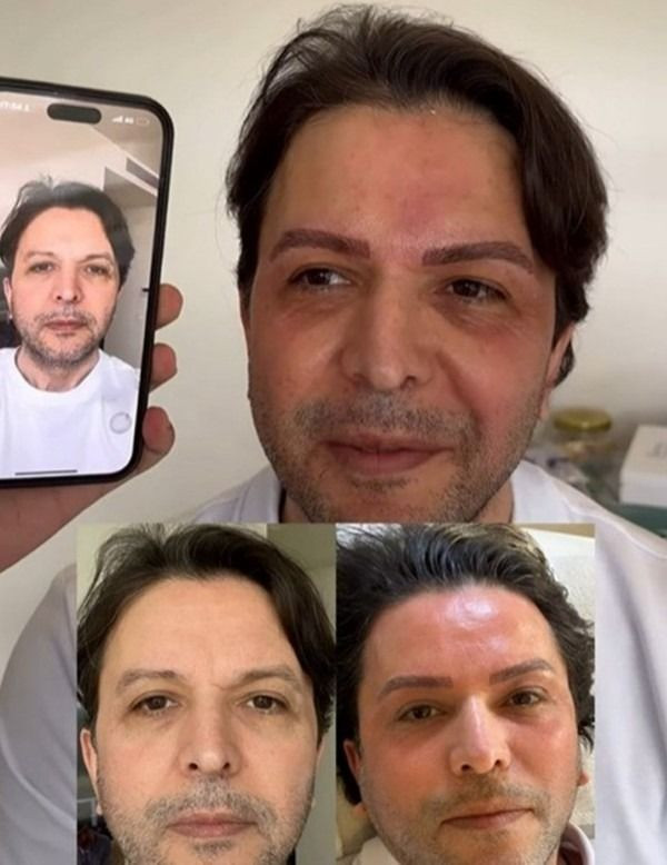 Estetik furyasına Nihat Doğan da katıldı: Son hali gündem oldu - Sayfa 3
