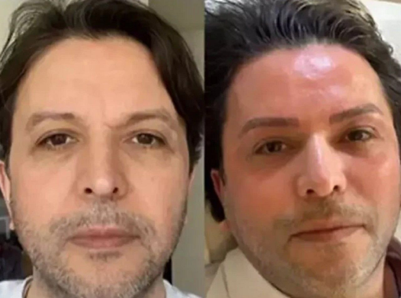Estetik furyasına Nihat Doğan da katıldı: Son hali gündem oldu - Sayfa 4