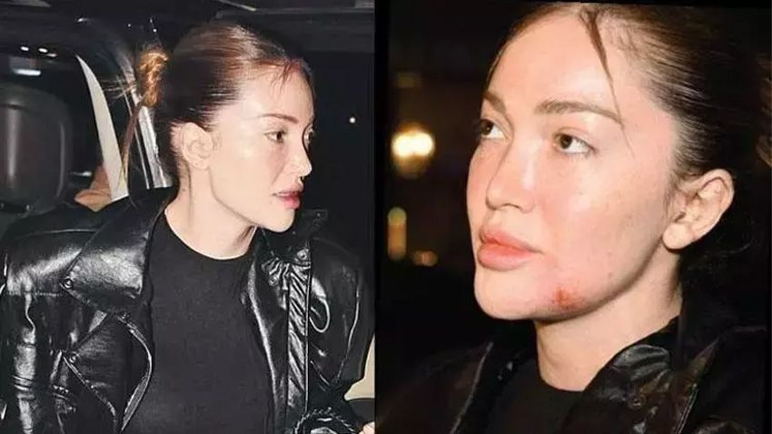 Danla Bilic'e kalça dolgusu kabusu... Doktorunu suçlayıp ismini açıkladı! - Sayfa 1