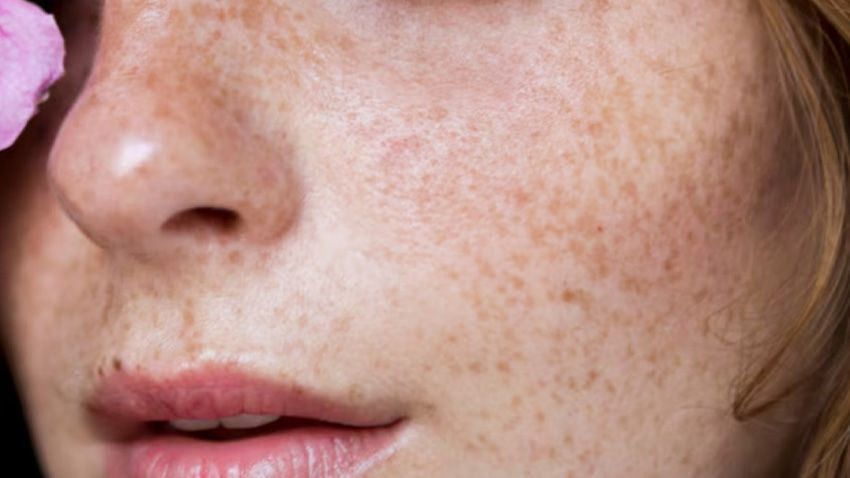 Bin yıllık reçete! İbn-i Sina’dan güneş lekelerine doğal formül - Sayfa 1