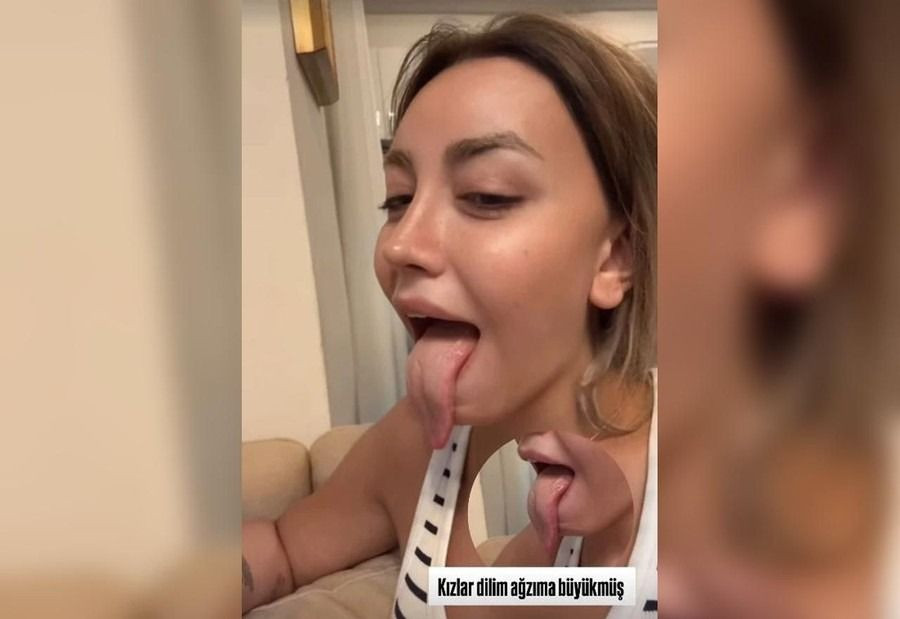 Fenomen Mika Can Raun'dan olay estetik kararı! "Ağızıma büyükmüş..." - Sayfa 4