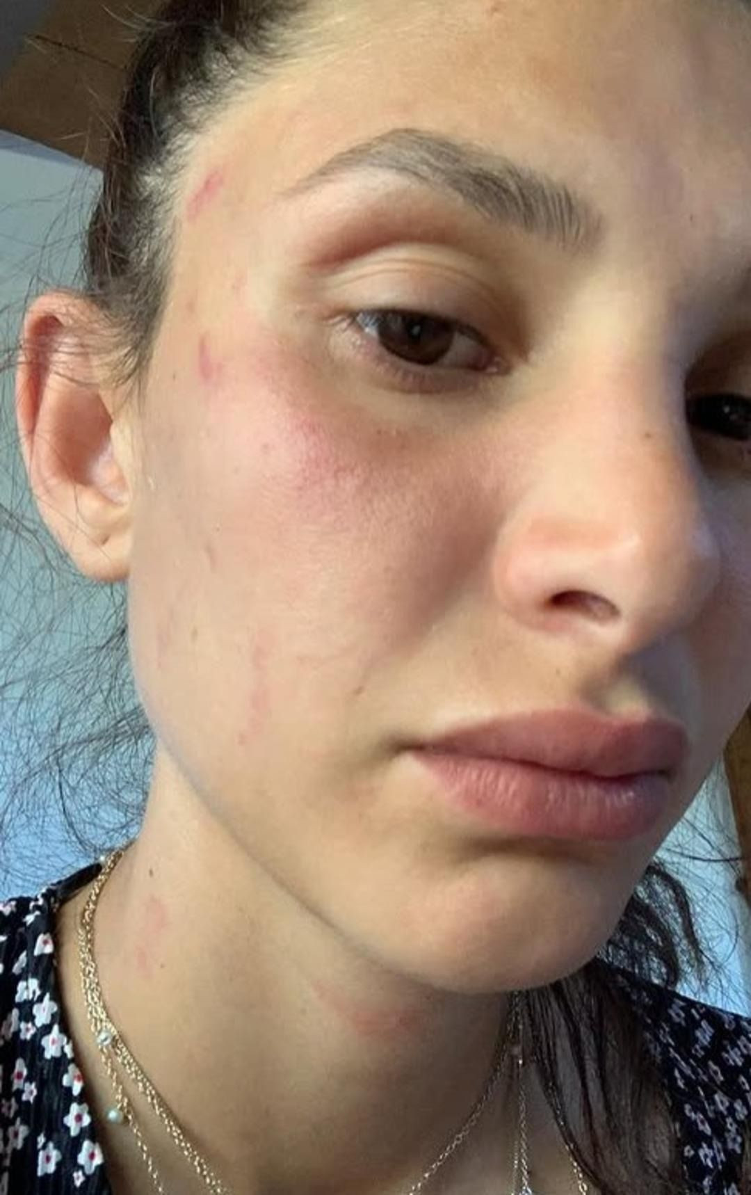 Can Yaman’ın sevgilisinden şiddet itirafı! Evli olduğu söylenmişti, yüzü kanlar içinde paylaştı! - Sayfa 4