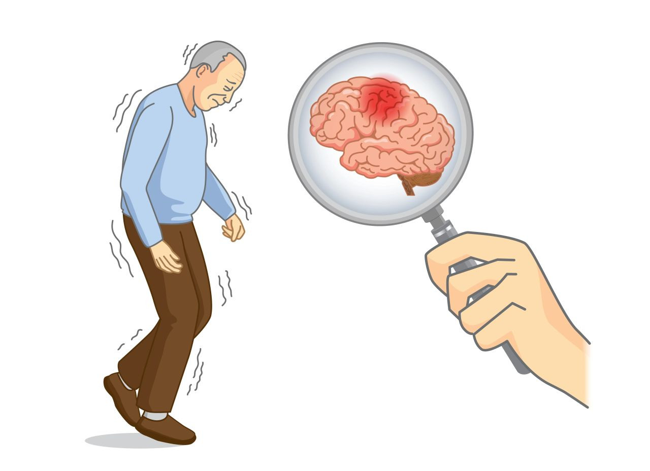 Parkinson Hastalığını Önlemek Mümkün Mü? İşte Uzmanların Parkinson Hastalığına Karşı 7 Altın Önerisi - Sayfa 1