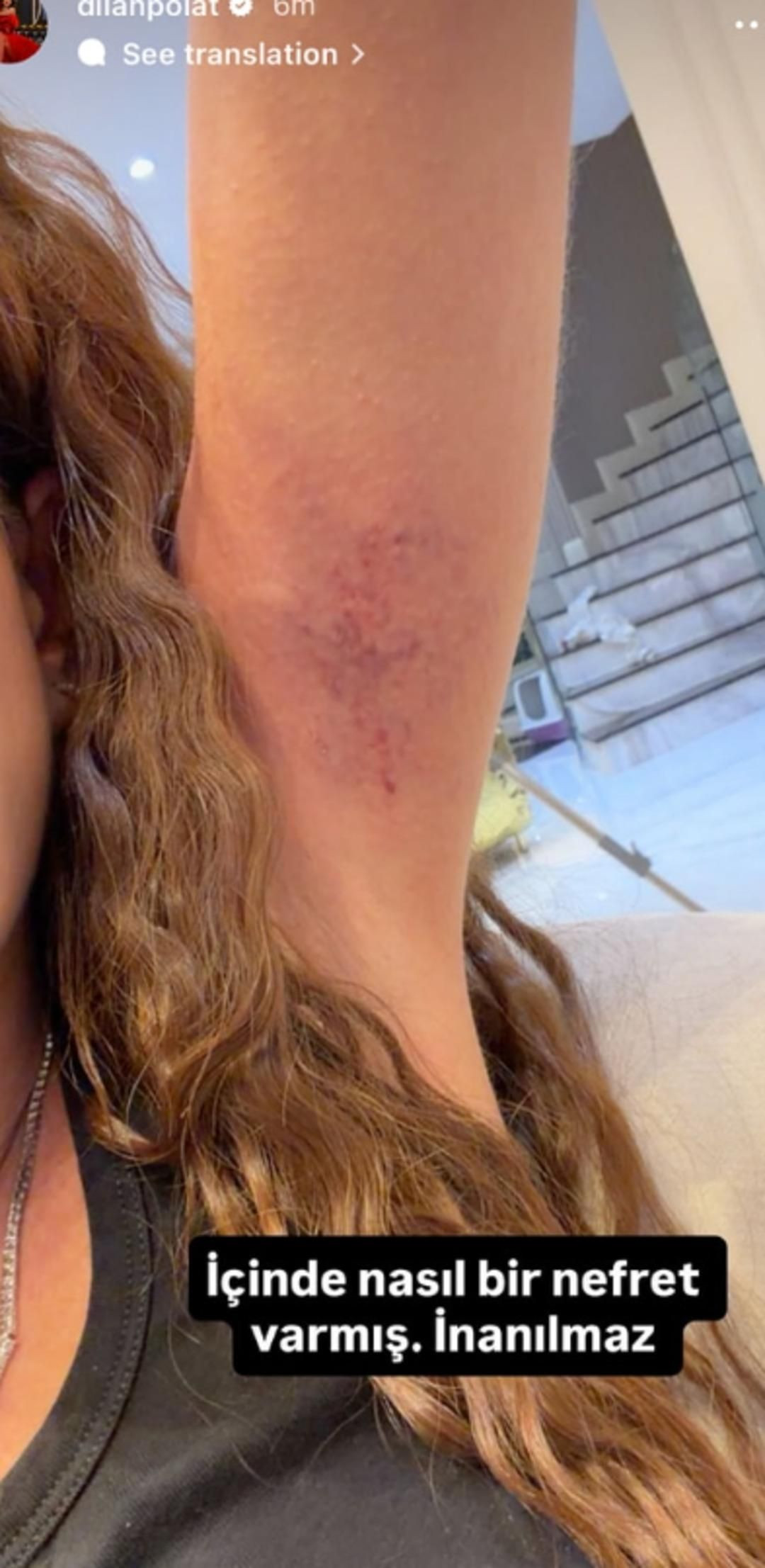 Dilan Polat ile Sıla Doğu arasında şoke eden kavga! Saçlarını kopardı, kollarını morarttı... - Sayfa 5