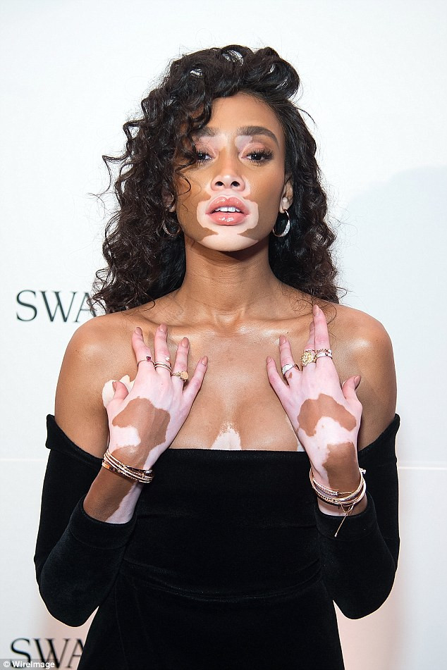 Hastalığını avantaja çevirdi: Winnie Harlow - Sayfa 8