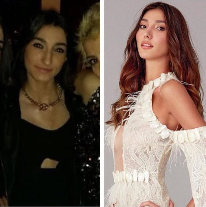 Miss Turkey 2018 güzeli "estetik harikası" çıktı! Tacı geri mi alınacak? - Sayfa 6